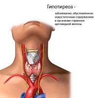 Заболевание щитовидной железы - гипотиреоз