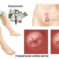 Кольпоскопия шейки матки: кому, зачем и как делают кольпоскопию